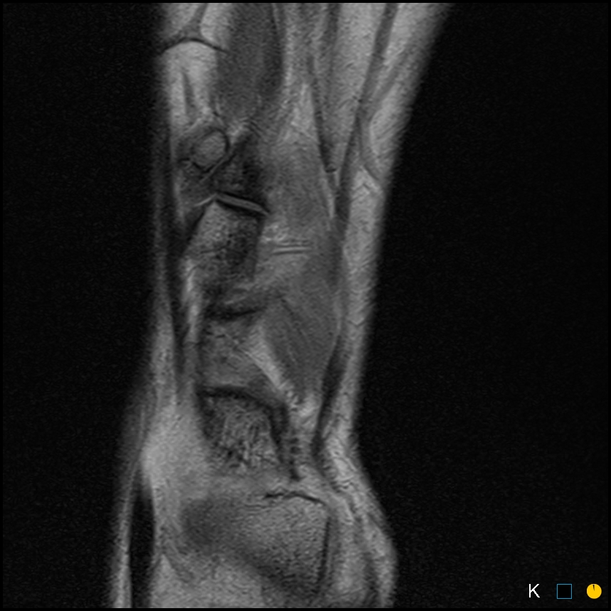Figure 5 for case Symptomatic os intermetatarseum